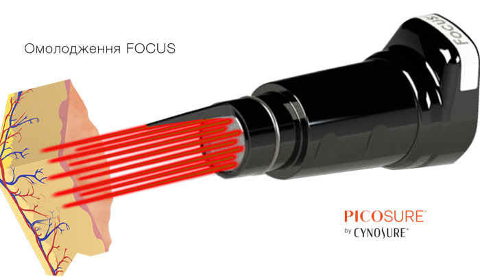 пікосекундний фракційний лазер PicoSure з Focus Lens Array 