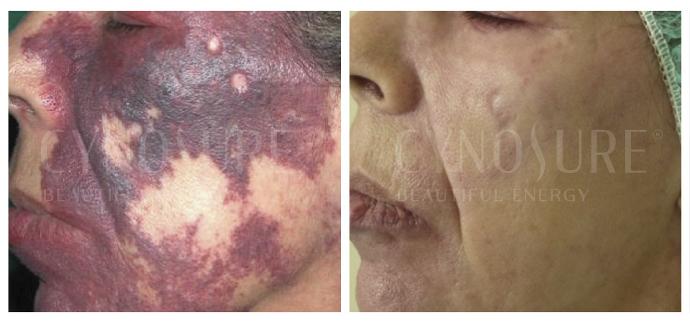 Удаление винного пятна на лице сосудистым лазером Cynergy фото до и после