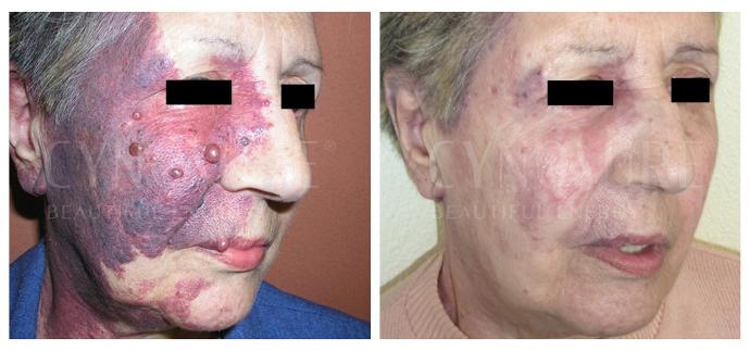 Удаление гемангиом на лице сосудистым лазером Cynergy фото до и после
