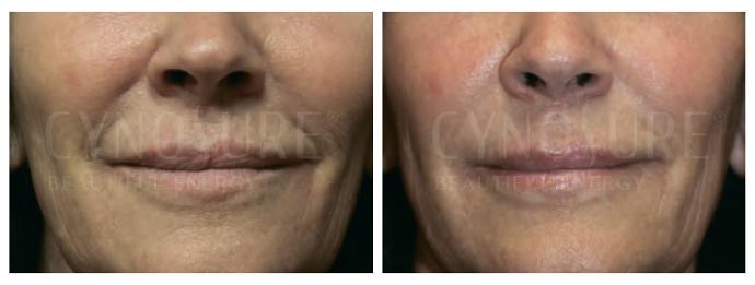 лицо, фото до и после процедуры микрогольчатого RF