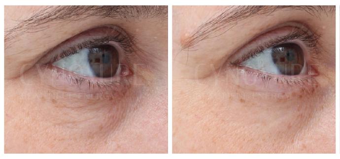 RF лифтинг вокруг глаз аппаратом TempSure Envi, фото до и после
