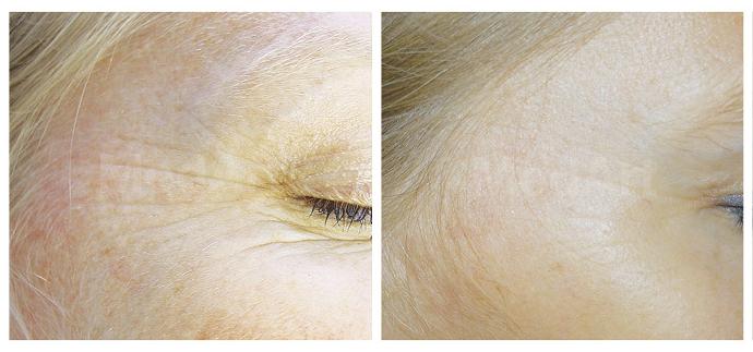 Морщины вокруг глаз, шлифовка фракционным лазером MedArt INTENZ фото до и после процедуры